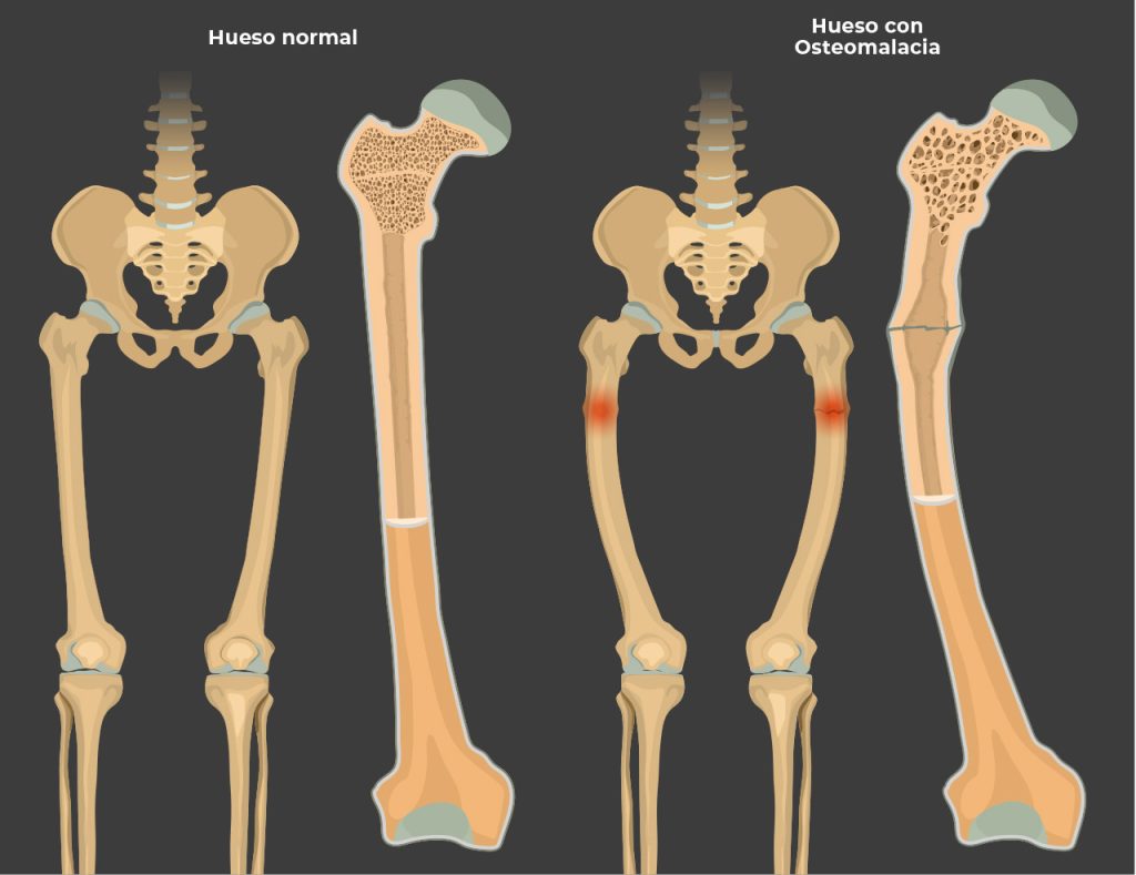 Qué es la osteomalacia OseaMx